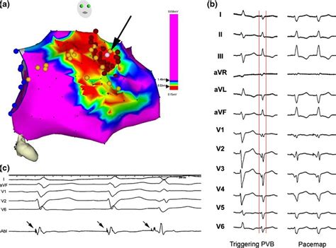 A Electroanatomical Map Of The Left Ventricle In Patient After