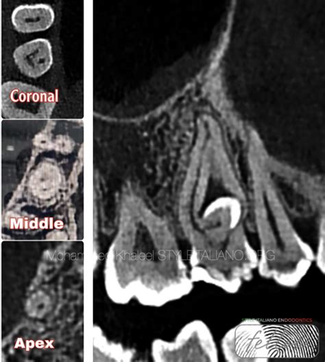 Dens invaginatus - Style Italiano Endodontics