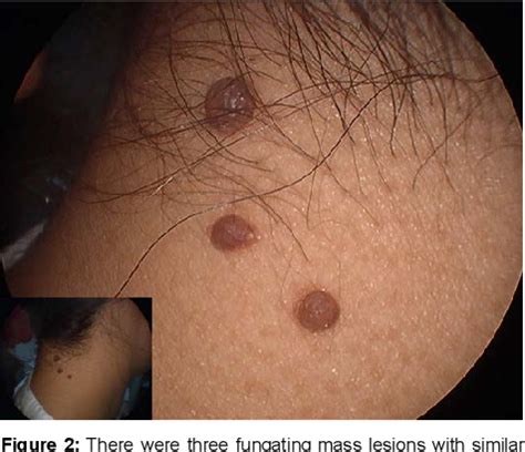 Figure From A Case Of Huge Intradermal Melanocytic Nevus Of The