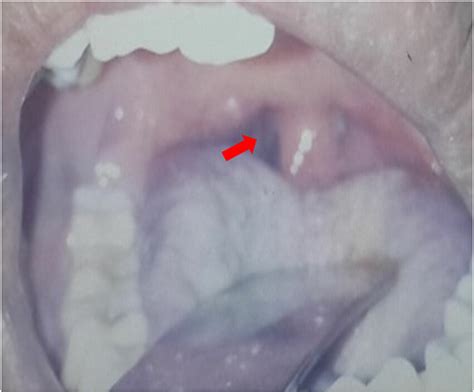 The Oropharynx Area After Incision Where The Isthmus Faucium Is More