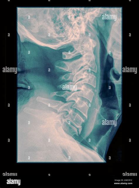 X Rays Cervical Hi Res Stock Photography And Images Alamy