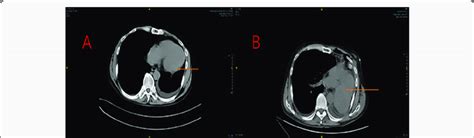 Preoperative Enhanced Computed Tomographic Scan Versus Enhanced