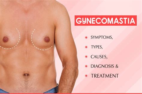 Gynecomastia Gynaecomastia Symptoms Causes And Treatment