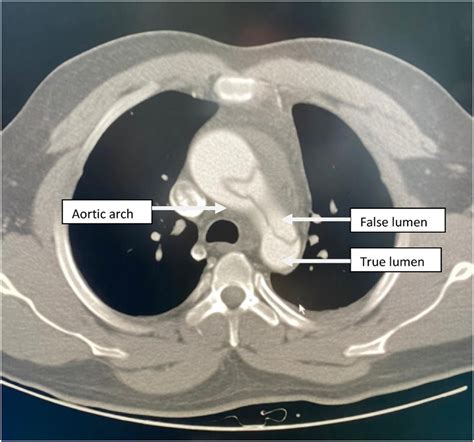 Aortic Arch On Ct Scan