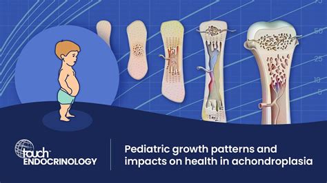 Achondroplasia Vs Normal