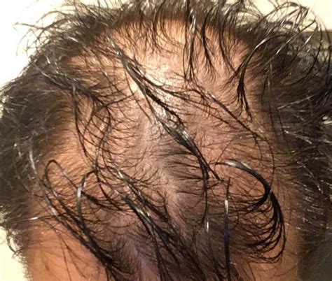 3 Years On Finasteride And Minoxidil Photo Wrassman M D Baldingblog