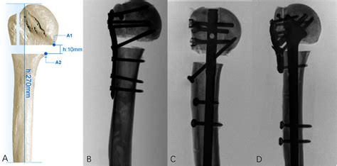 Frontiers Biomechanical Evaluation Of Novel Intra And Extramedullary