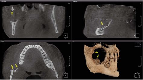 Multilocular Ameloblastoma On Cone Beam Computed Tomographic Images A