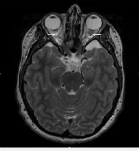 T2 weighted axial MRI through the suprasellar cistern Bilateral optic ...