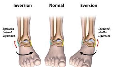 Condition Spotlight Sinus Tarsi Syndrome Watsonia Podiatry