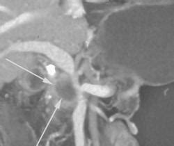 Cm Pancreatic Cancer Encases The Portal Vein And Superior Mesenteric