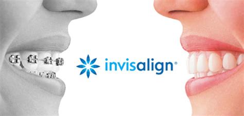 A Closer Look At Invisalign Clear Braces Forest Edge Dental