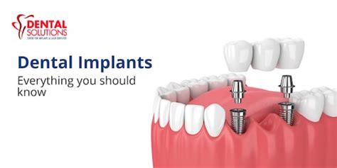 Dental Implants Types Advantages Procedure Cost And Risks Best