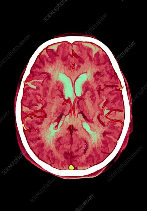 Cerebral Arteries Ct Scan Stock Image C Science Photo