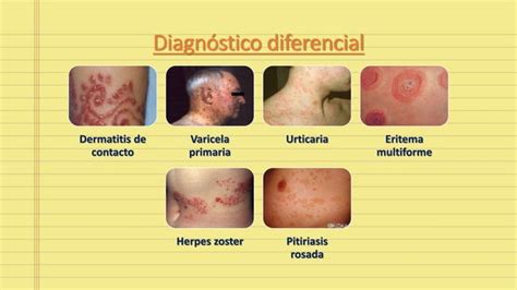 Herpes Z Ster Diseminado Ppt