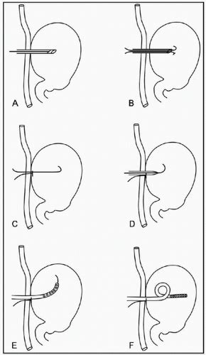 Endoscopic Gastrostomy Percutaneous Tube Peg Jejunostomy Placement