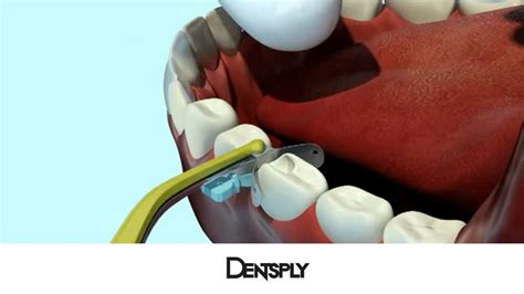 Sistema De Matrices Palodent V3 De Dentsply YouTube