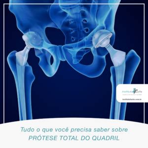 Etapas Para A Cirurgia De Pr Tese Total Do Quadril Tratamento De