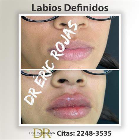 Correcci N De Labios Dr Eric Rojas Dermatolog A Laser Center