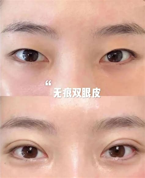 北京丽合稳健雕鼻：胎生稳健骨雕鼻对个人形象的重要性 哔哩哔哩