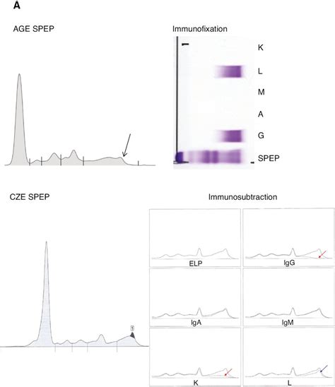 Representative Immunofixation Electrophoresis And Immunosubtraction In