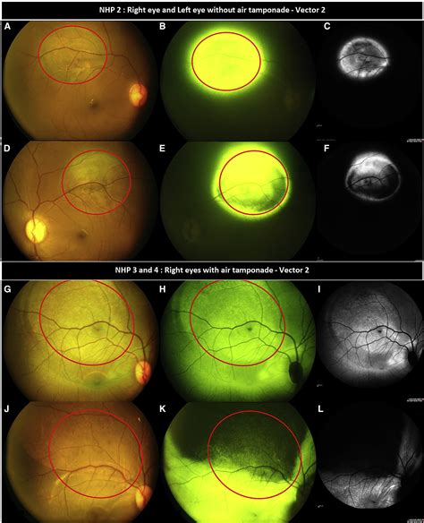 Intravitreal Air Tamponade After Aav2 Subretinal Injection Modifies