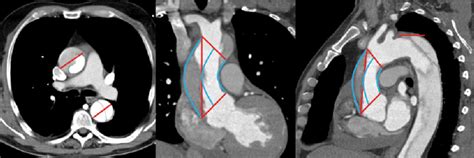 Measurements Of Aortic Diameters And Length Left Transverse Plane