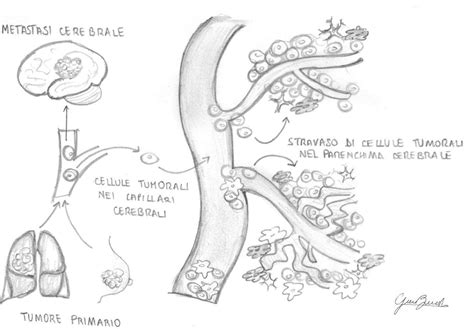 Metastasi cerebrale Cosa è e sintomi Dott Paolo Ferroli