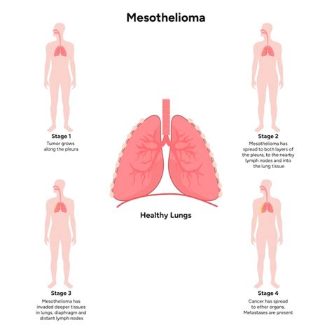 Premium Vector 4 Stages Of Mesothelioma Lung Disease