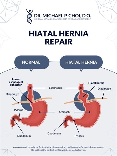 Hiatal Hernia Repair In South Florida Dr Michael Choi