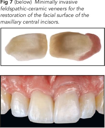 Figure 7 From Minimally Invasive Treatment Of An Ankylosed Severely Discolored And Intruded