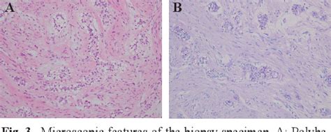 Peripheral Clear Cell Variant Of Calcifying Epithelial Odontogenic