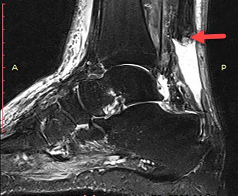 Understanding Full Thickness Achilles Tendon Rupture Diagnosis