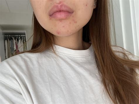 Acne Around Mouth Keeps Coming Back What To Do Racne