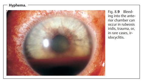 Acute Iritis And Iridocyclitis