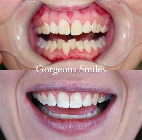 Braces Before And After Pictures - Gorgeous Smiles