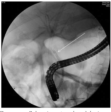 Figure 1 From Management Of Impacted Common Bile Duct Stones In Late Stage Pregnancy And