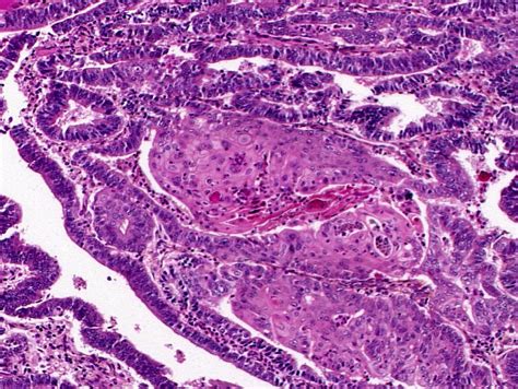 Histopathology and cytopathology of the uterine cervix - digital atlas - glossary