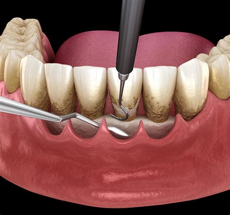 Periodontal Disease Treatment Austin Tx