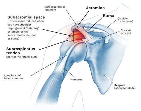 Shoulder impingement cause and treatment with 4 exercises