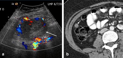 A 15 Year Old Girl With Sex Cord Tumor With Annular Tubules Ultrasound Download Scientific