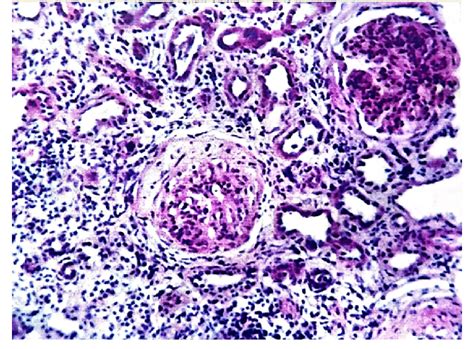 Diffuse Proliferative Glomerulonephritis Class Iv With Marked Download Scientific Diagram