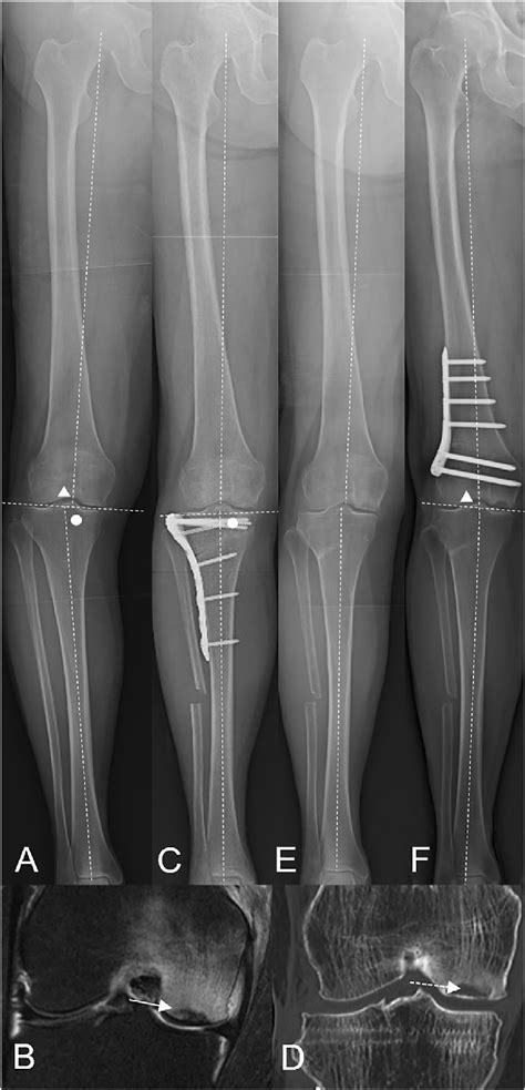 Additional Dfo Case In Table A Full Length Anteroposterior