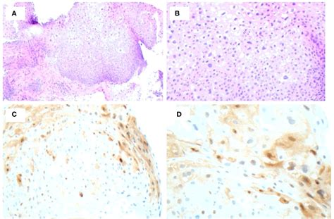 Frontiers Case Report Resolution Of High Grade Anal Squamous Intraepithelial Lesion With