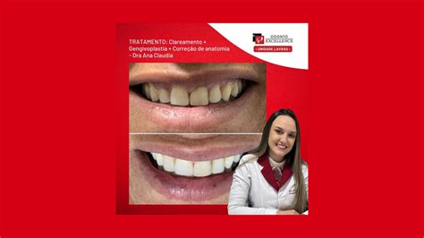 Tratamento Completo Para Um Sorriso Renovado E Na Odonto Excellence