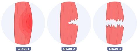 Hamstring Tear Grades