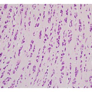 Photomicrographs Showing Small Round Cells Arranged In Indian File