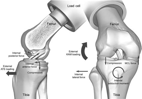 Schematic Of Injury Mechanism Left External Loading Of Anterior