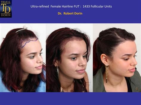 Dr. DORIN - FEMALE Hairline FUT - Bald Truth Talk - Hair Loss, Hair ...