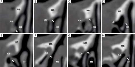 Positions of insertion of the UP into the lacrimal sac fossa. (A-D)... | Download Scientific Diagram